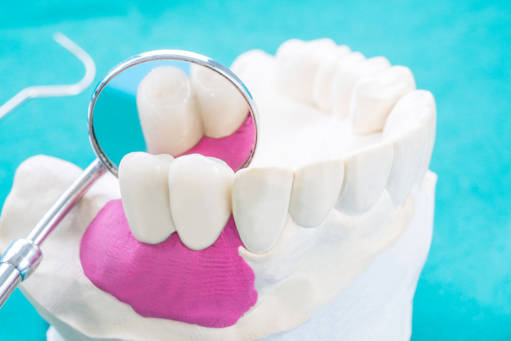 Crown & Fixed Bridges Blenheim Family Dental