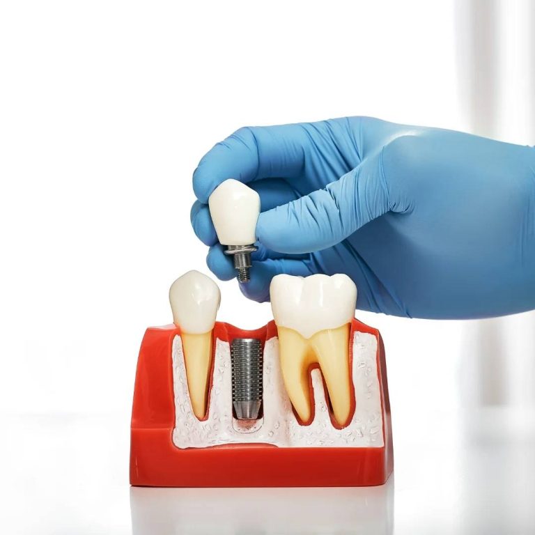 Implant Dentistry in Blenheim, ON